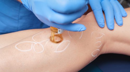 Lasertherapie