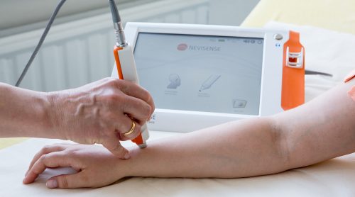 schwarzer hautkrebs vorsorge nevisense